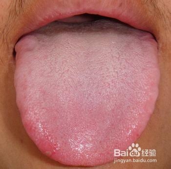颤动舌:舌体伸出时出现不自主的颤动,由于肝阳上亢,热盛动风或气虚